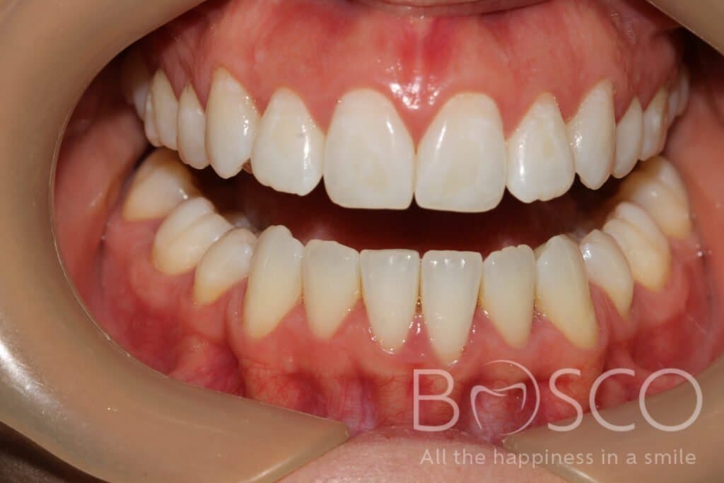 Dark and translucent teeth