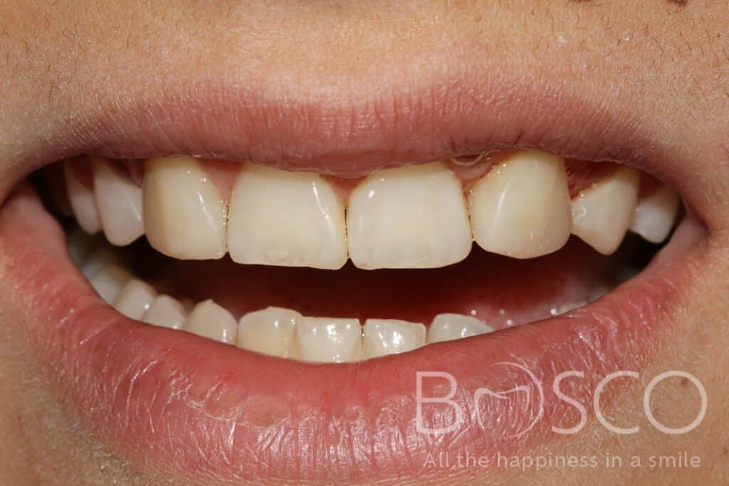 Spaced teeth