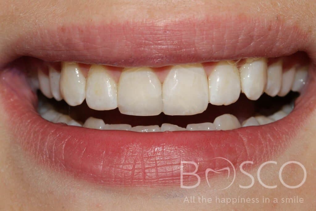 Broken and worn teeth