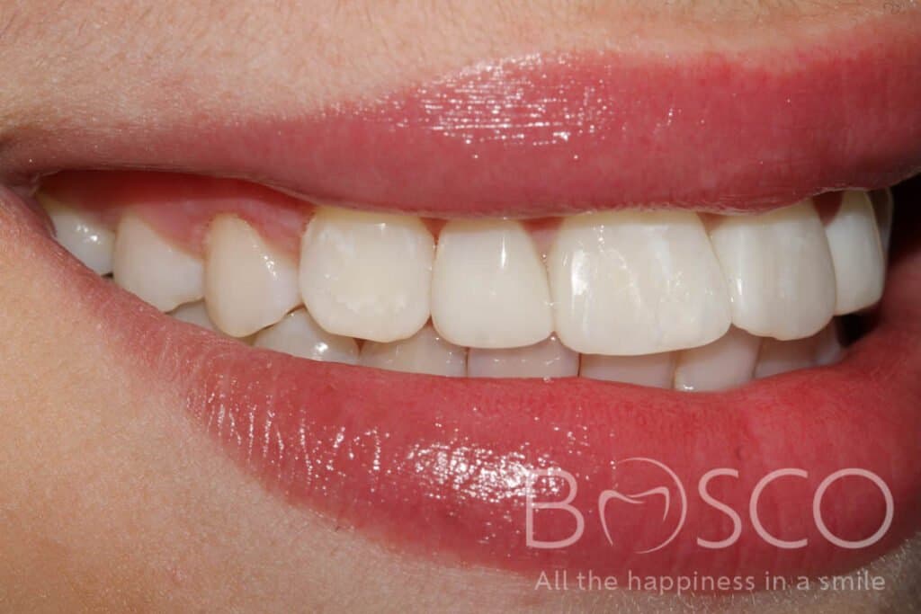 Malformed and misaligned teeth